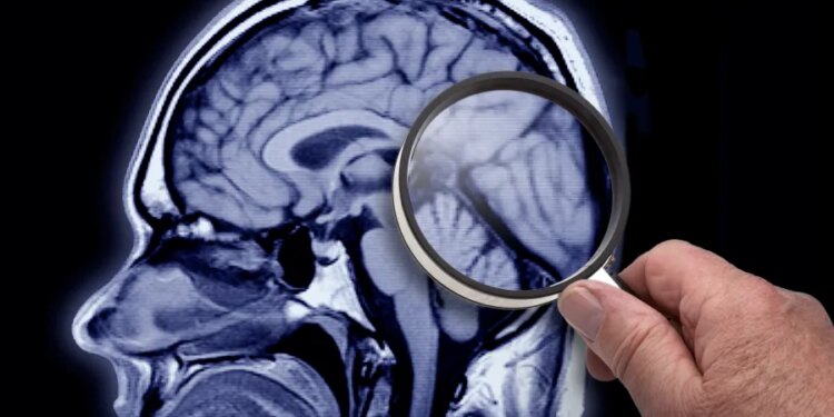 INTERVIEW: Yale neurologist talks link between menopause, Alzheimer's disease