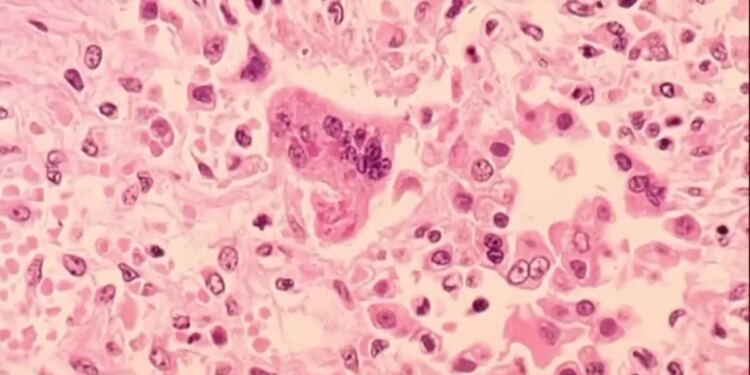 DPH confirms state's second measles case, first in a vaccinated adult