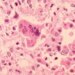 DPH confirms state's second measles case, first in a vaccinated adult