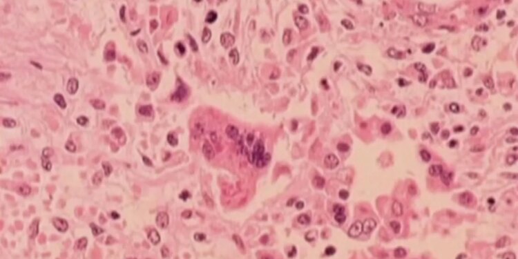 DPH confirms first case of measles in Connecticut this year