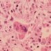 DPH confirms first case of measles in Connecticut this year