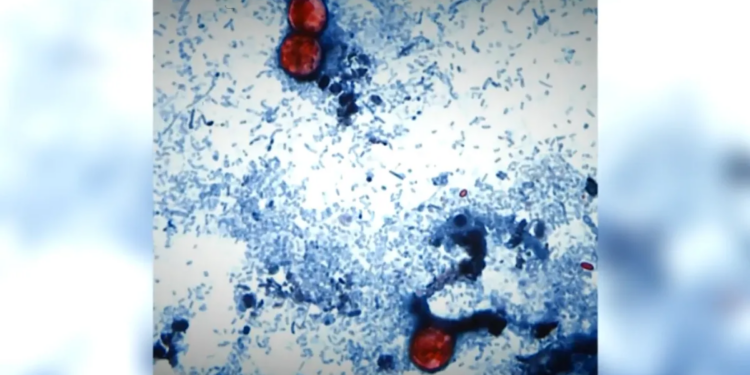 86 people have been hospitalized with foodborne parasite spreading across the U.S., CDC says