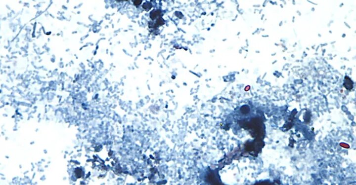 40 cases of cyclosporiasis confirmed in Connecticut as cases rise nationwide