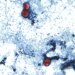 40 cases of cyclosporiasis confirmed in Connecticut as cases rise nationwide