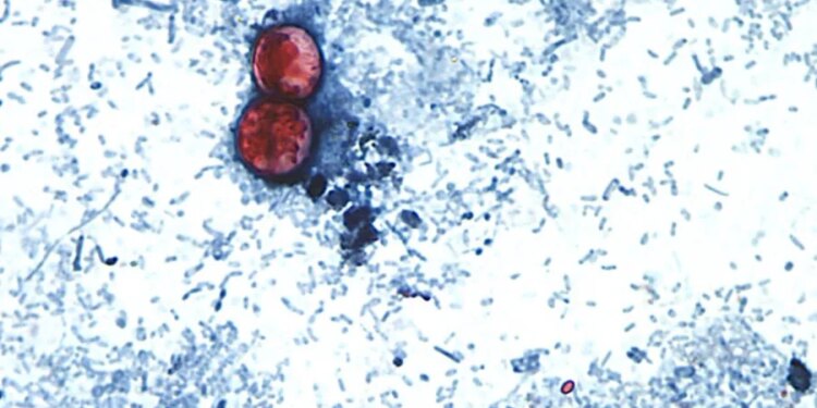 Map: Where cases of 'explosive' diarrhea-causing parasitic illness have been reported