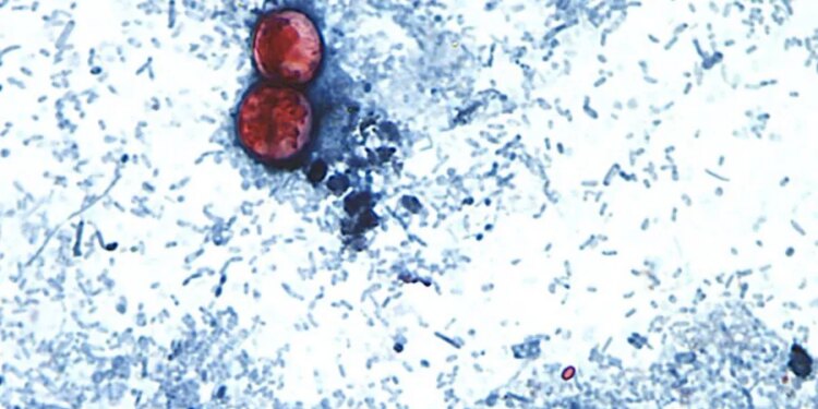 Number of Cyclospora cases in Connecticut continue to rise