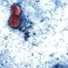 Number of Cyclospora cases in Connecticut continue to rise