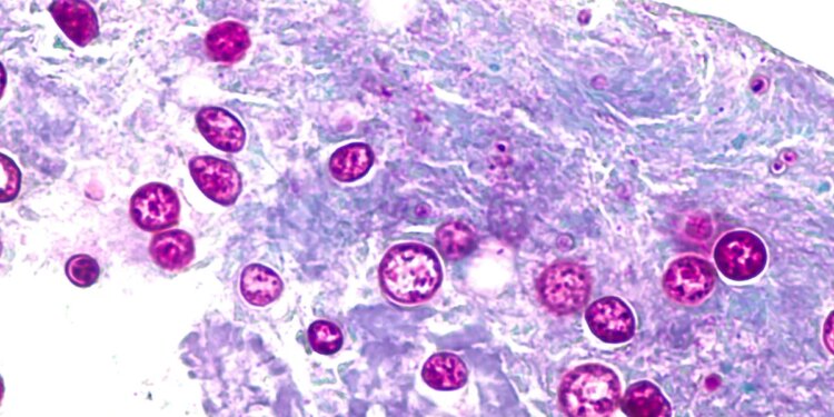 Cyclosporiasis outbreaks: What to know about the foodborne illness and symptoms