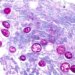 Cyclosporiasis outbreaks: What to know about the foodborne illness and symptoms