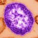 Connecticut reports third measles case of 2026