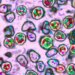 Recent measles case confirmed as third in Connecticut this year, DPH says