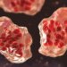 Third measles case of 2026 reported in Connecticut